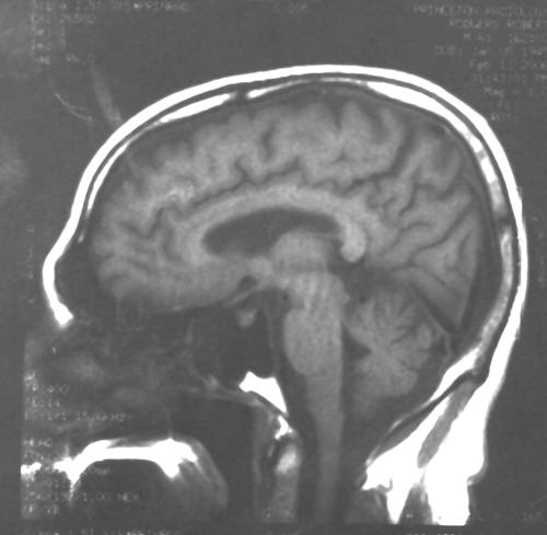 MRI of Bob's Brain